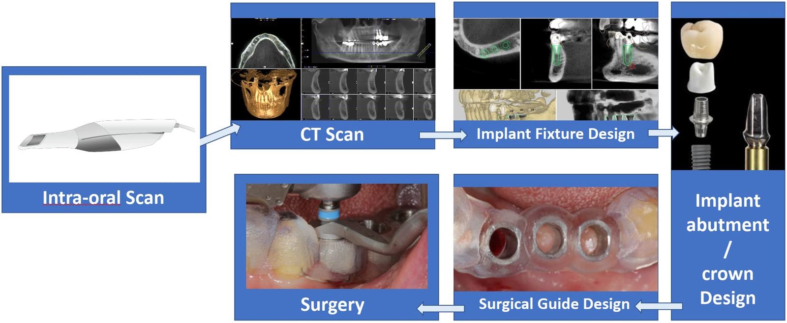 Digital protocol for a one-day implant: intra-oral scan, CT scan, implant fixture design, implant abutment and crown design, surgical guide design and surgery