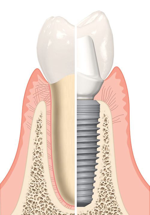 Illustration comparing a natural tooth with a dental implant