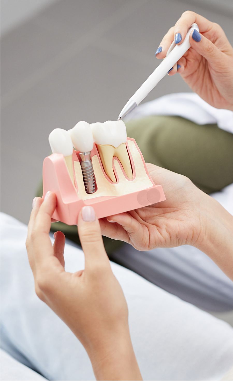Dental implant model held by a dentist