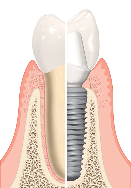 natural-tooth-vs-implant