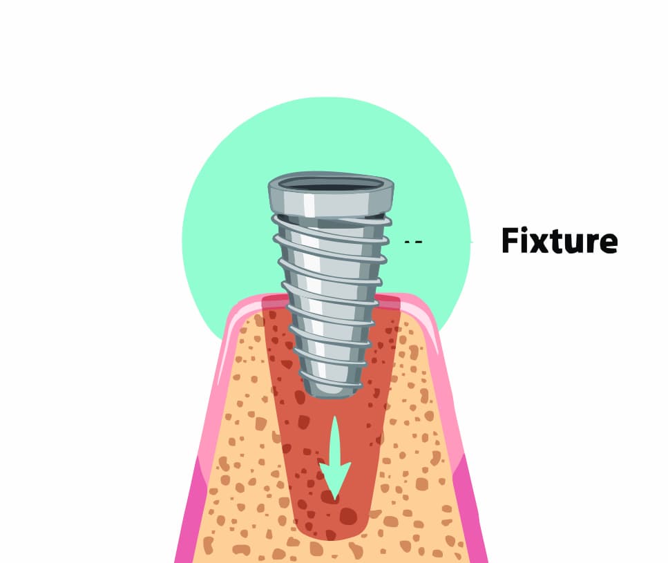 implant-process--1