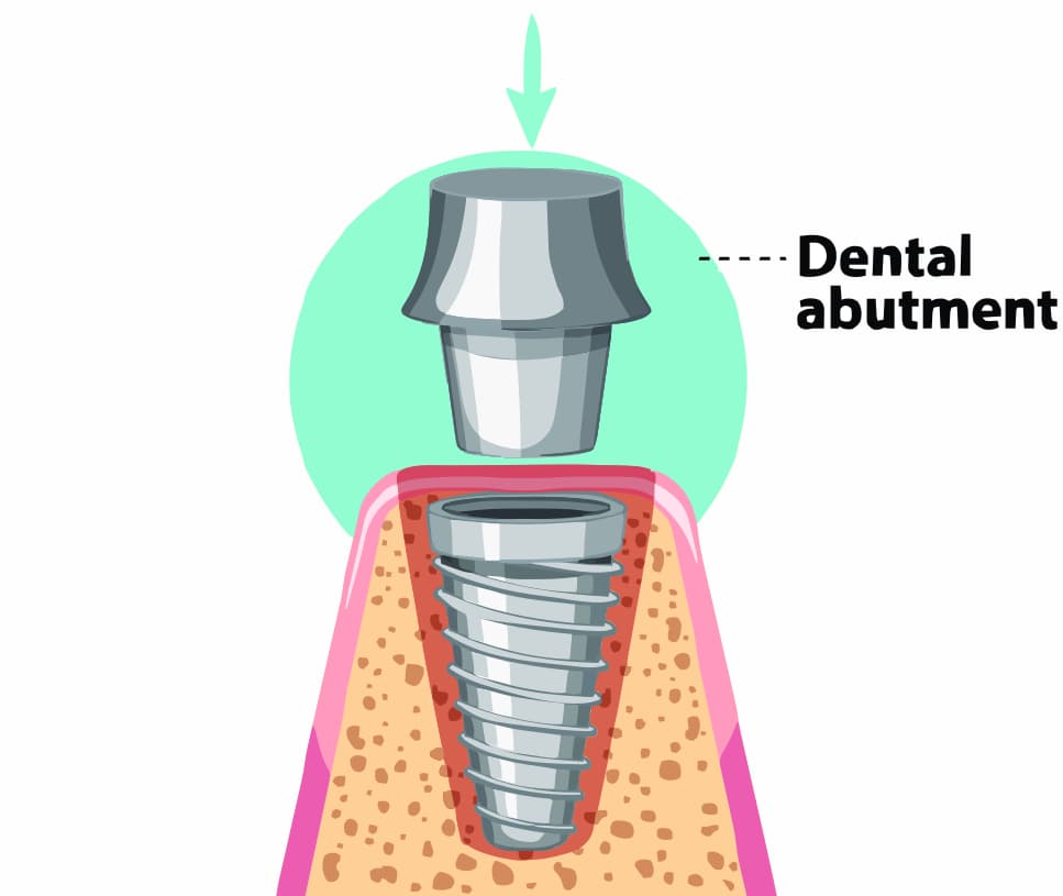 implant-process--2