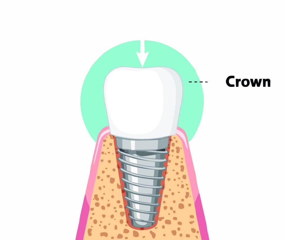 implant-process--3